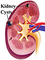 Kidney cyst